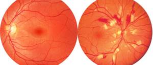 Лечение ангиопатии сетчатки глаз и профилактика осложнений