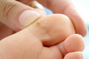Бородавки на ногах: причины и лечение медикаментозными средствами