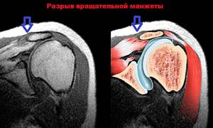 Как проводится магнитно-резонансная томография плечевого сустава