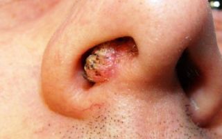 Папилломы в носу: разновидности и методы лечения наростов