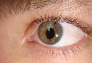 Симптомы отслоения сетчатки глаза и прогноз при заболевании