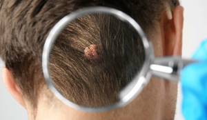 Папилломы на голове: симптомы и методы лечения новообразований