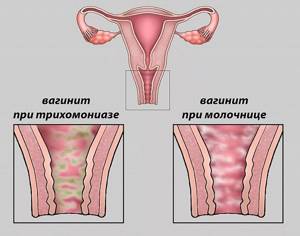 Симптомы и основные методы лечения вульвовагинита у женщин