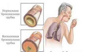 Приступы кашля: при каких заболеваниях возникают и как лечатся