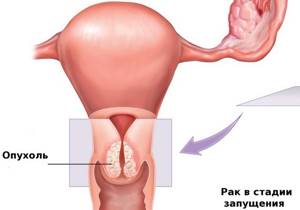 Папилломы генитальные: признаки появления и методы лечения