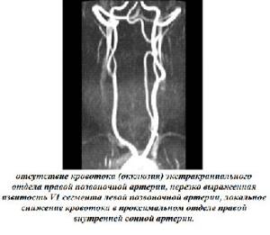 Как проводится магнитно-резонансная томография сосудов шеи