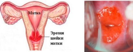 Симптомы эктопии шейки матки и методы терапии заболевания