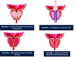 Заболевания предстательной железы: классификация и лечение