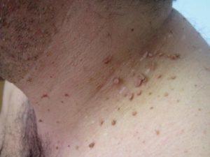 Бородавка на шее: причины и лечение опасных новообразований