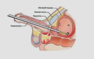 Папиллома мочевого пузыря у мужчины: диагностика и лечение