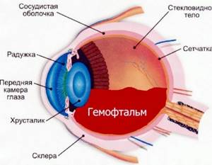 Лечение гемофтальма и профилактика развития заболевания глаз