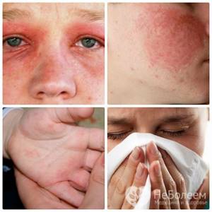 Лечение аллергии на холод и способы купирования проявлений недуга