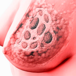 Гормоны при мастопатии: причины дисбаланса и методы лечения